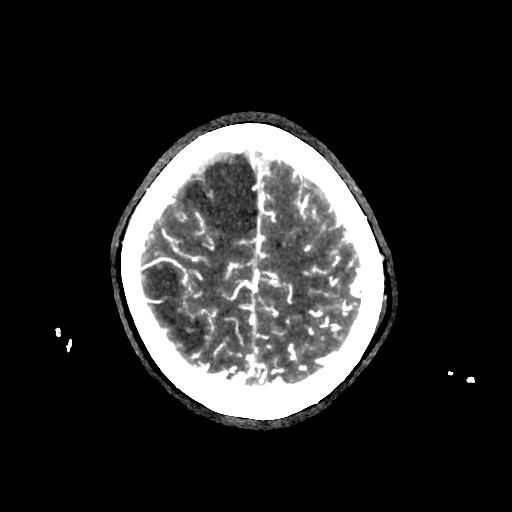 File:Cerebral venous thrombosis - hemorrhagic venous infarction (Radiopaedia 87318-103613 Axial 202).jpg
