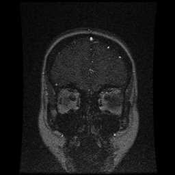 Cerebral venous thrombosis - ulcerative colitis (Radiopaedia 66049-75219 Coronal MRV 97).jpg