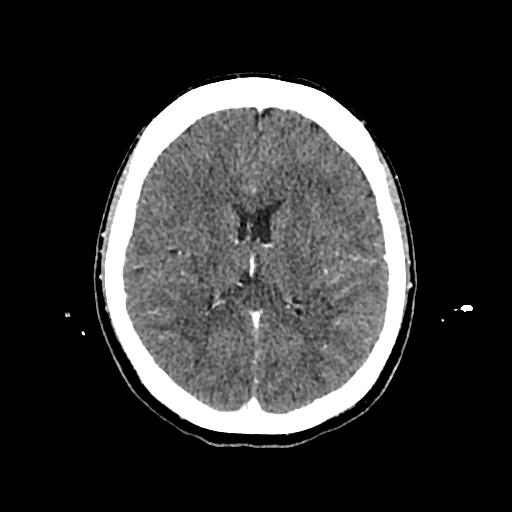 Cerebral venous thrombosis with venous hemorrhagic infarct (Radiopaedia 90354-107660 Axial with contrast 98).jpg
