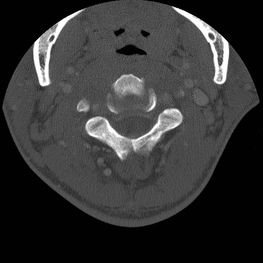 Cervical Pott disease (Radiopaedia 20374-20286 Axial bone window 45).jpg