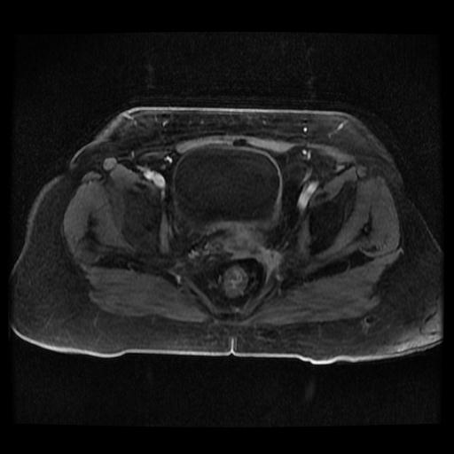 Cervical carcinoma (Radiopaedia 70924-81132 Axial T1 C+ fat sat 49).jpg