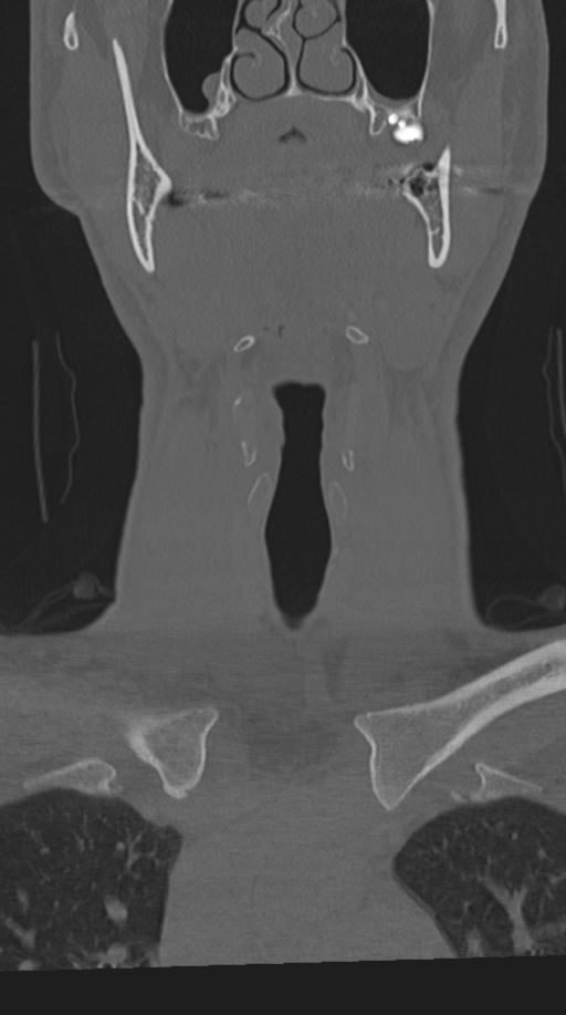 Cervical intercalary bone (Radiopaedia 35211-36748 Coronal bone window 8).png