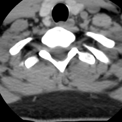 Cervical schwannoma (Radiopaedia 57979-64974 Axial non-contrast 56).png