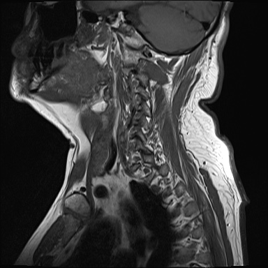 File:Cervical spinal neurofibroma in a patient with NF1 (Radiopaedia 58344-65465 Sagittal T1 1).jpg