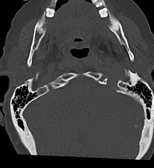 Cervical spine ACDF loosening (Radiopaedia 48998-54070 Axial bone window 8).png