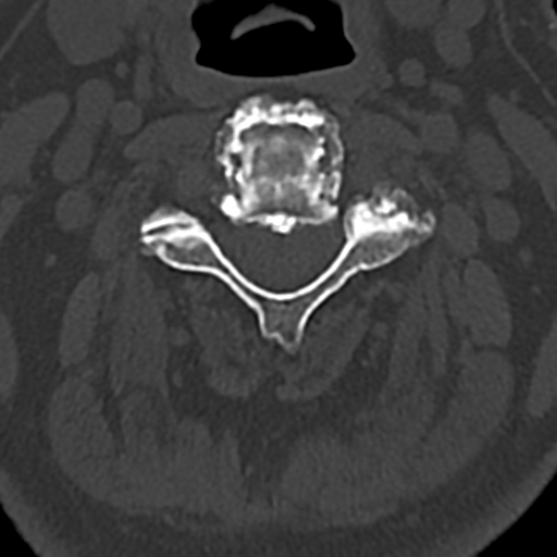 File:Cervical spine fracture - chalk stick (Radiopaedia 39116-41323 Axial bone window 36).png