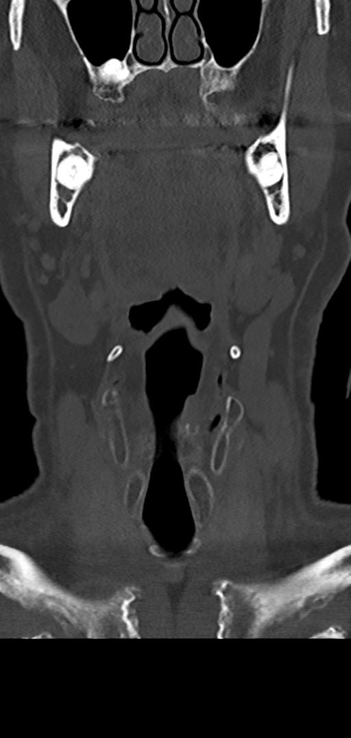 Cervical spine fracture - chalk stick (Radiopaedia 39116-41323 Coronal bone window 2).png