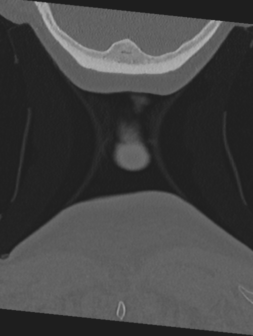 Cervical spondylolysis (Radiopaedia 49616-54811 Coronal bone window 73).png