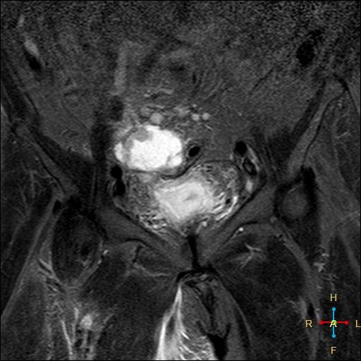 File:Cervical stump squamous cell carcinoma (Radiopaedia 48049-52858 G 2).jpg