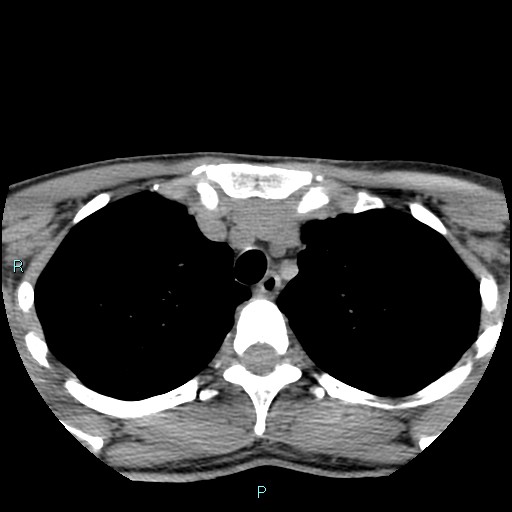 Cervical thymic cyst (Radiopaedia 88632-105335 Axial non-contrast 11).jpg