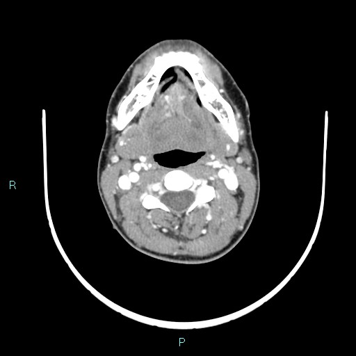 Cervical thymic cyst (Radiopaedia 88632-105335 B 75).jpg