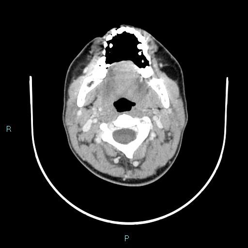 Cervical thymic cyst (Radiopaedia 88632-105335 C 85).jpg