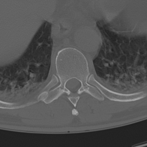Chance fracture (Radiopaedia 33854-35020 Axial bone window 61).png