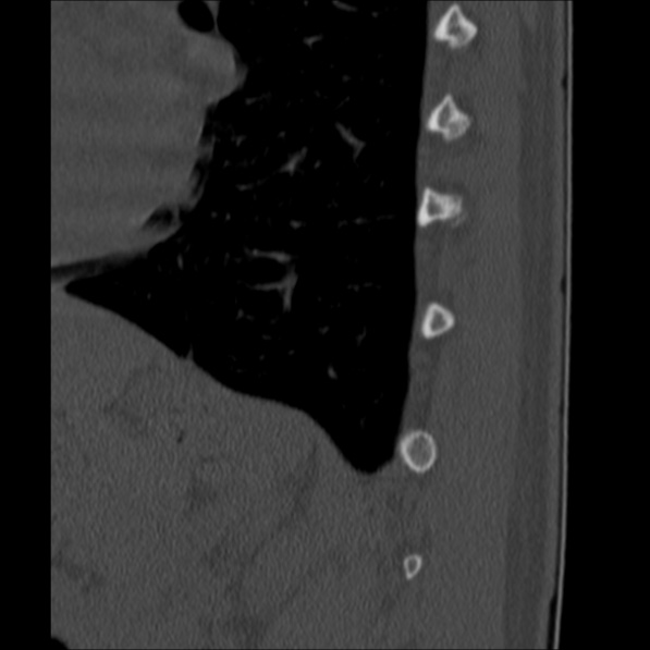 Chance fracture (Radiopaedia 36521-38081 Sagittal bone window 65).jpg