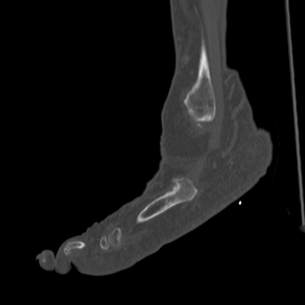 Charcot joint (Radiopaedia 36629-38194 Sagittal bone window 27).jpg