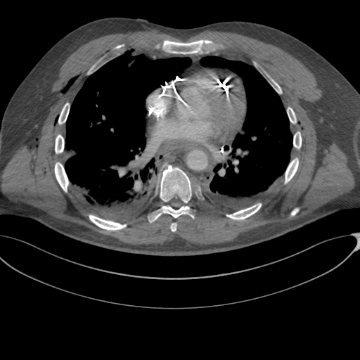 File:Chest multitrauma - aortic injury (Radiopaedia 34708-36147 A 171).png