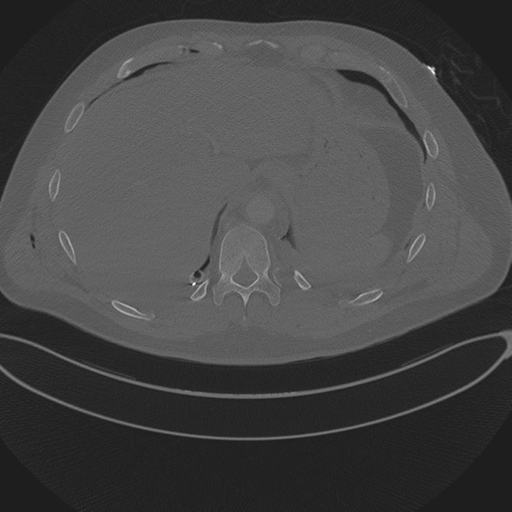 File:Chest multitrauma - aortic injury (Radiopaedia 34708-36147 Axial bone window 258).png