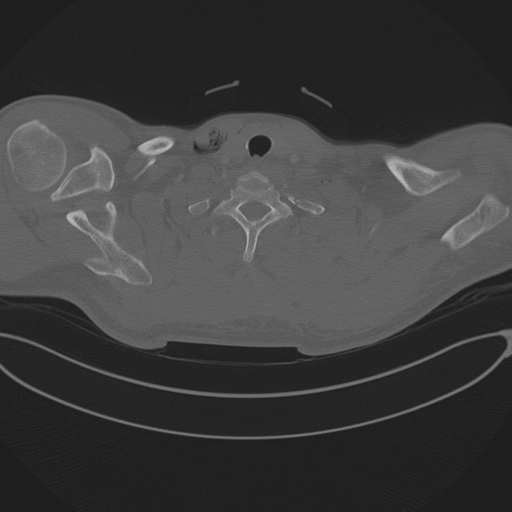 Chest multitrauma - aortic injury (Radiopaedia 34708-36147 Axial bone window 7).png