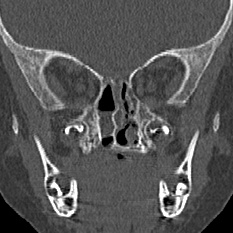 Choanal atresia (Radiopaedia 88525-105975 Coronal bone window 62).jpg