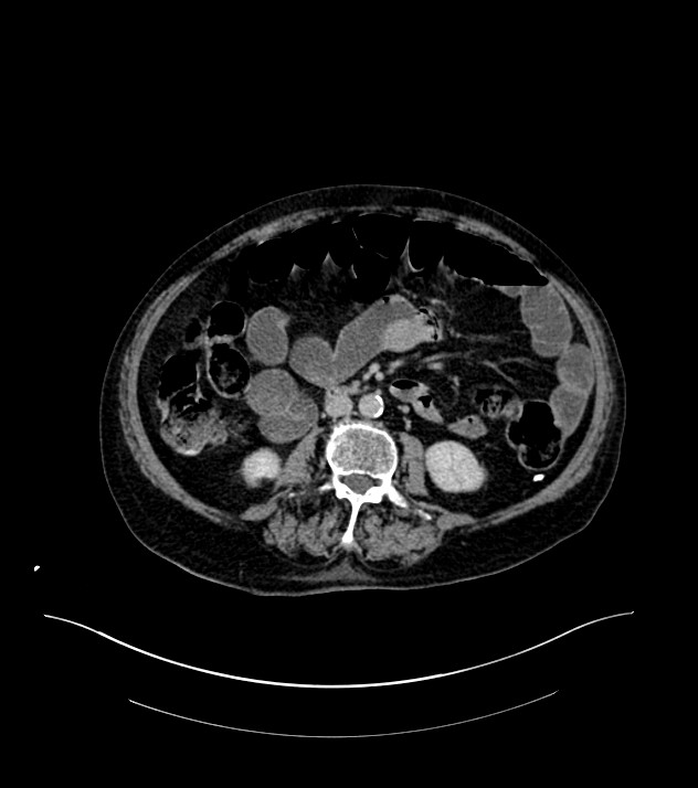 Cholangiocarcinoma with cerebral metastases (Radiopaedia 83519-98629 Axial C+ delayed 63).jpg