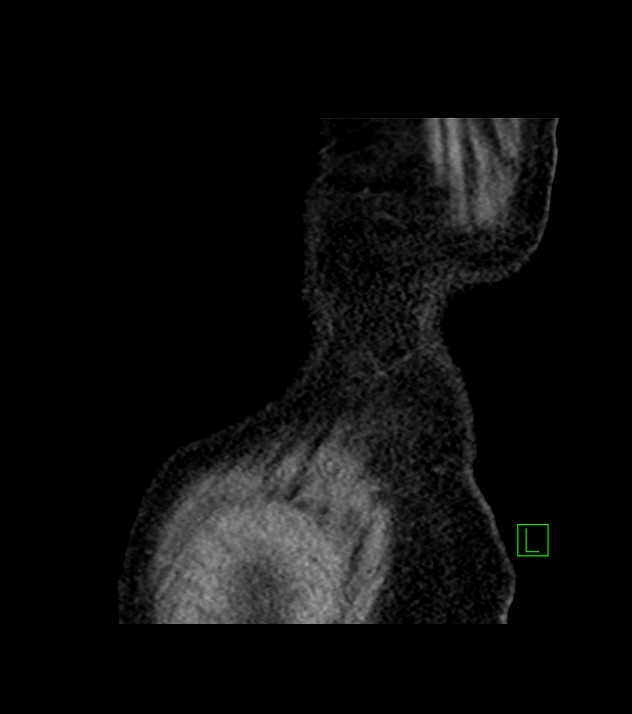 Cholangiocarcinoma with cerebral metastases (Radiopaedia 83519-98629 Sagittal C+ delayed 107).jpg