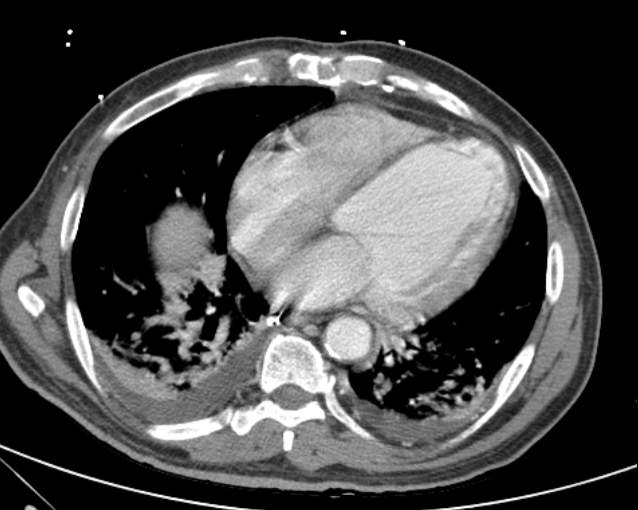 File:Cholecystitis - perforated gallbladder (Radiopaedia 57038-63916 A 7).jpg