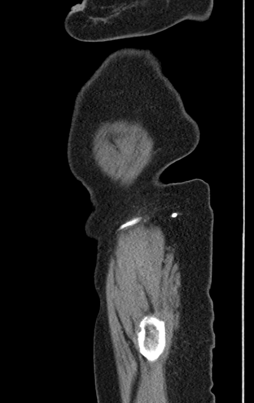 Cholecystoduodenal fistula due to calculous cholecystitis with gallstone migration (Radiopaedia 86875-103077 C 1).jpg