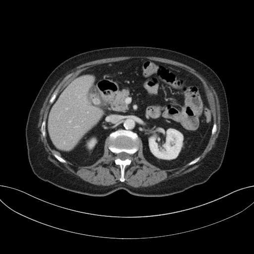 Cholecystoduodenal fistula due to calculous cholecystitis with gallstone migration (Radiopaedia 86875-103077 D 33).jpg