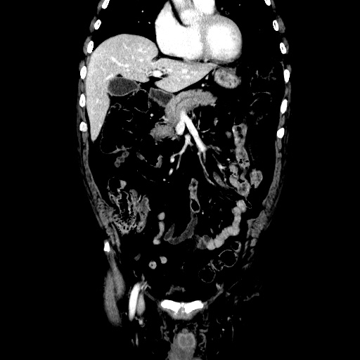 Choledocholiathiasis with normal caliber common bile duct (Radiopaedia 75368-86632 Coronal liver window 47).jpg