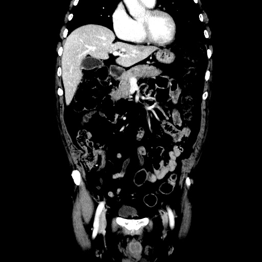 Choledocholiathiasis with normal caliber common bile duct (Radiopaedia 75368-86632 Coronal liver window 49).jpg
