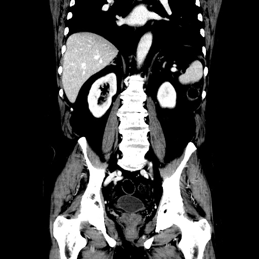 Choledocholiathiasis with normal caliber common bile duct (Radiopaedia 75368-86632 Coronal liver window 81).jpg