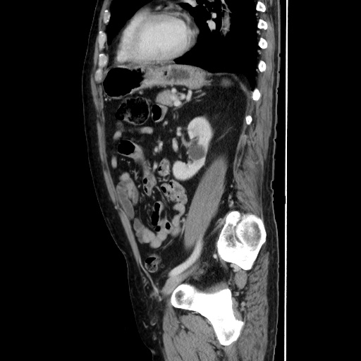 Choledocholiathiasis with normal caliber common bile duct (Radiopaedia 75368-86632 D 106).jpg