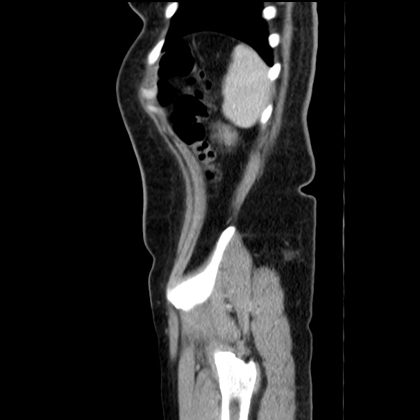 Choledocholithiasis on CT and MRI (Radiopaedia 24825-25087 D 56).jpg