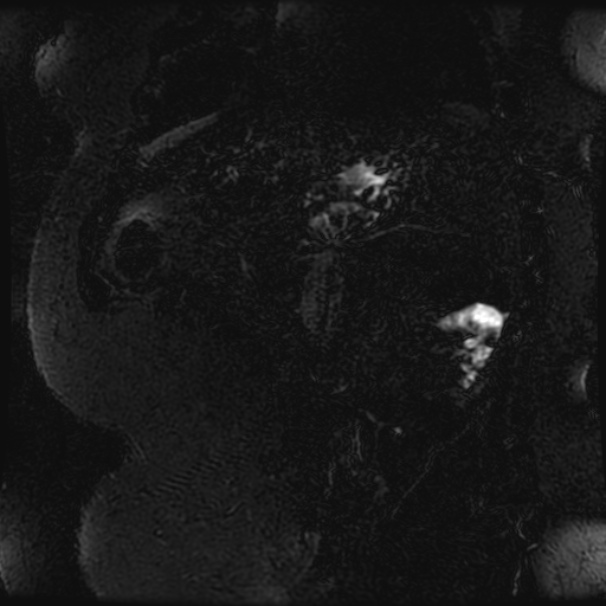 Choledocholithiasis on CT and MRI (Radiopaedia 24825-25088 Coronal T2 103).jpg