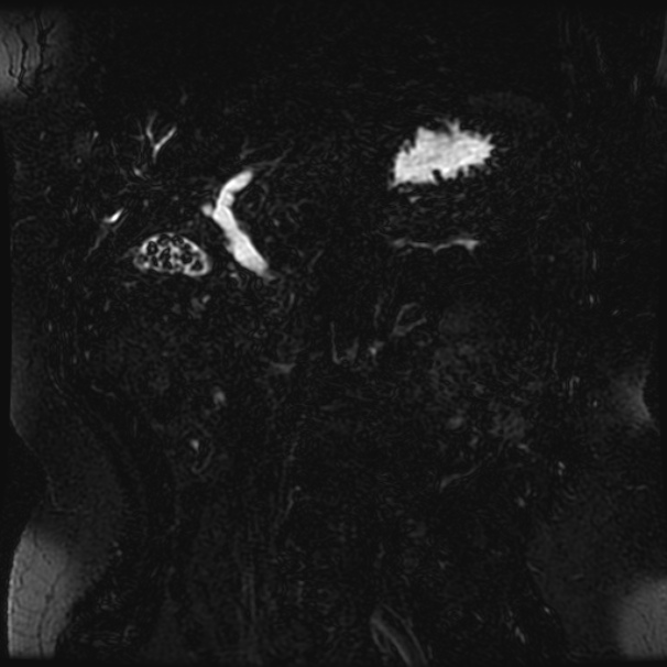 Choledocholithiasis on CT and MRI (Radiopaedia 24825-25088 Coronal T2 41).jpg