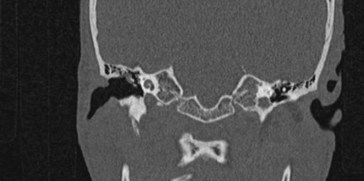 File:Cholesteatoma (Radiopaedia 70429-80529 Coronal bone window 9).jpg