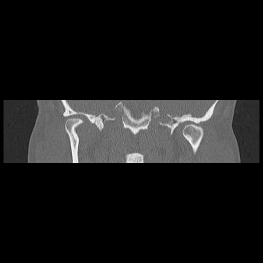 Cholesteatoma (Radiopaedia 84946-100455 Coronal bone window 87).jpg