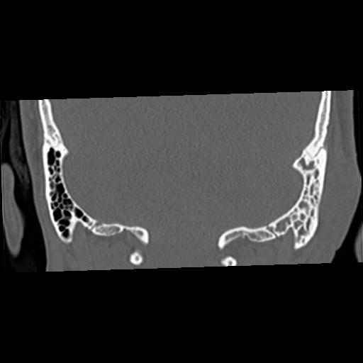 Cholesteatoma (Radiopaedia 84960-100474 Coronal bone window 54).jpg
