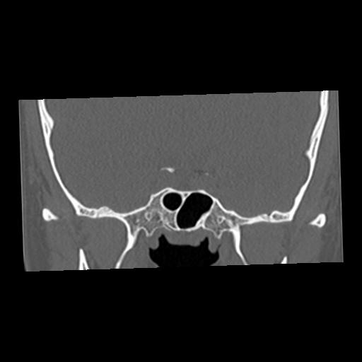 Cholesteatoma (Radiopaedia 84960-100474 Coronal bone window 8).jpg
