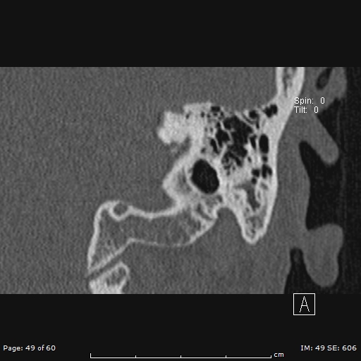 Cholesteatoma - external auditory canal (Radiopaedia 88452-105096 Coronal bone window 49).jpg