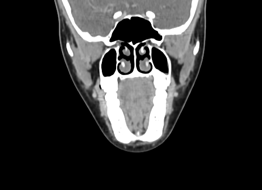 Chondroblastic osteosarcoma (Radiopaedia 67363-76741 D 40).jpg