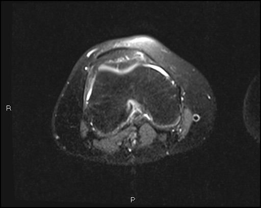 File:Chondroblastoma (Radiopaedia 62721-71031 Axial PD fat sat 16).jpg