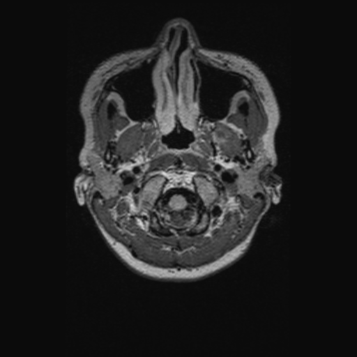 Chondrosarcoma (Radiopaedia 41937-44939 Axial FLAIR 8).png
