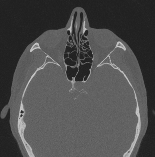 Chondrosarcoma (clivus) (Radiopaedia 46895-51425 Axial bone window 35).png