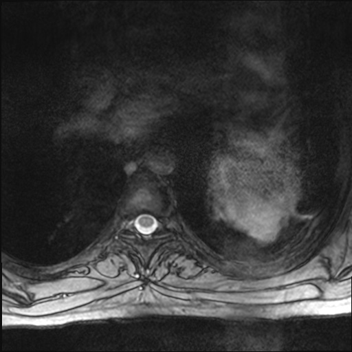 File:Chondrosarcoma - chest wall (Radiopaedia 65192-74200 Axial Gradient Echo 32).jpg