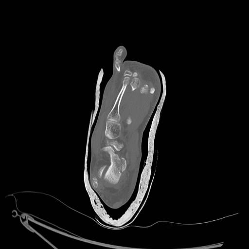 File:Chopart fracture (Radiopaedia 12386-12650 Axial bone window 1).jpg
