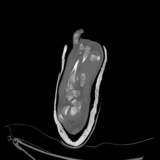 File:Chopart fracture (Radiopaedia 12386-12650 Axial bone window 4).jpg