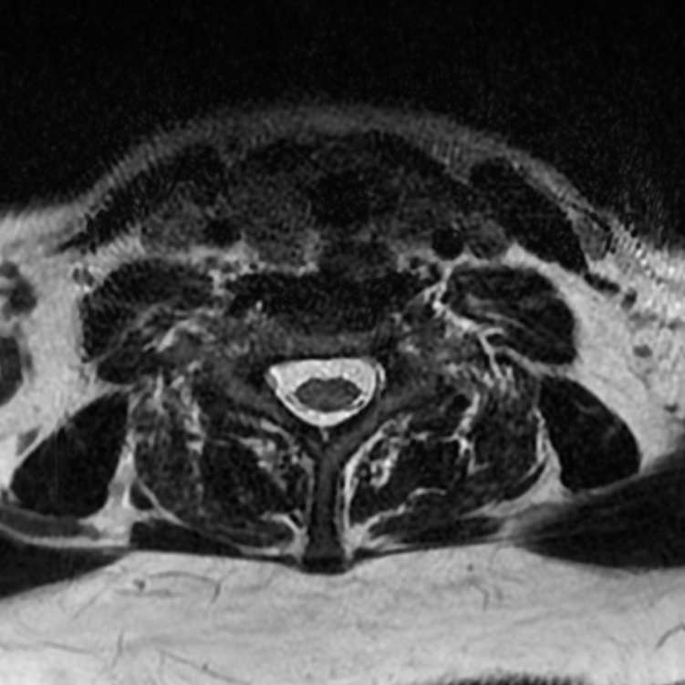 Chordoma - cervical spine (Radiopaedia 70084-80111 Axial T2 71).png