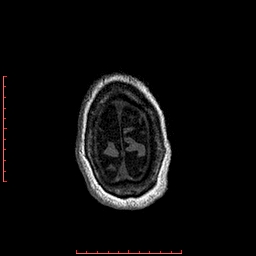 Choroid plexus xanthogranuloma (Radiopaedia 67843-77270 Axial T1 24).jpg