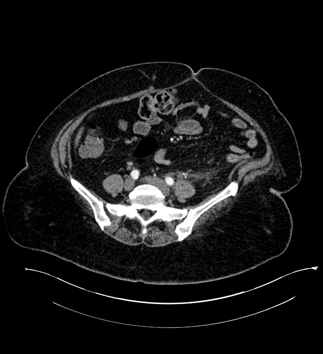 Chromophobe renal cell carcinoma (Radiopaedia 84239-99519 B 85).jpg